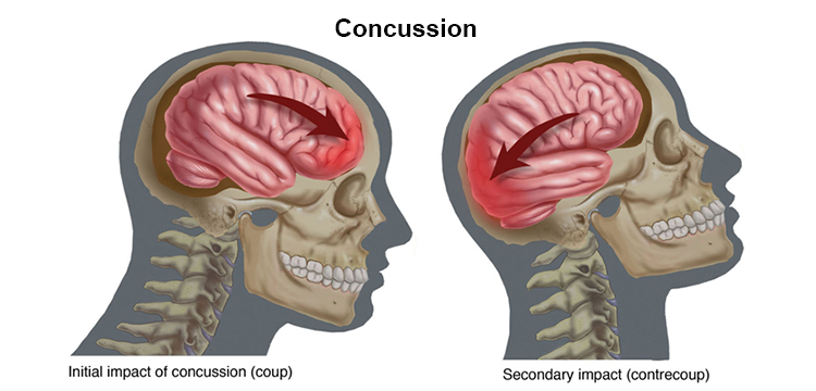 Why Properly Documenting Concussions is Vital to Athlete Health